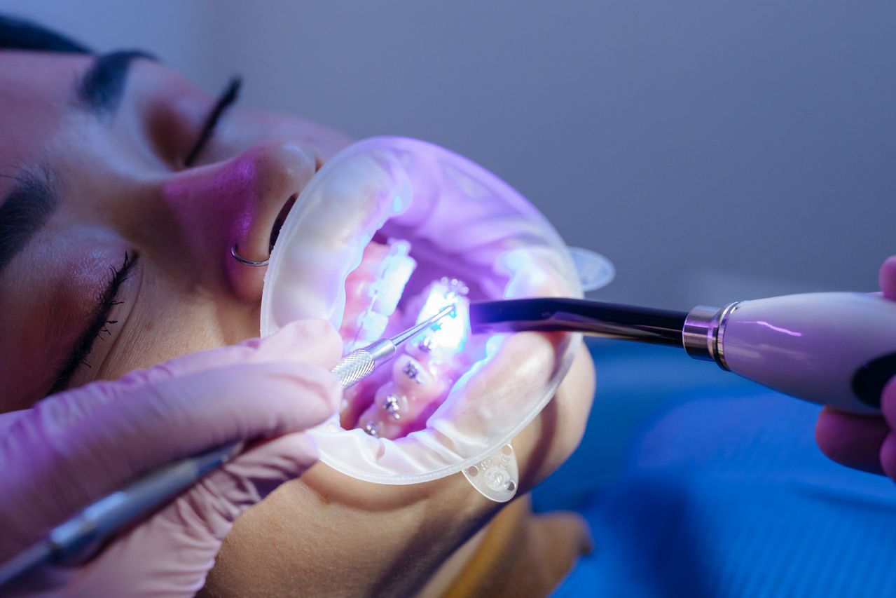 Braces Cost Basingstoke | Orthodontic Treatment Guide